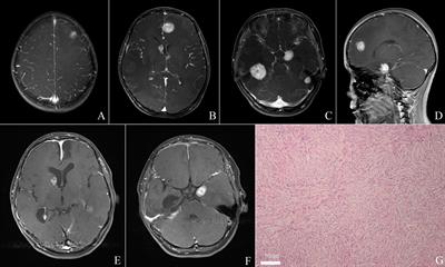 Multifocal Desmoplastic Infantile Ganglioglioma/Astrocytoma (DIA/DIG): An Institutional Series Report and a Clinical Summary of This Rare Tumor